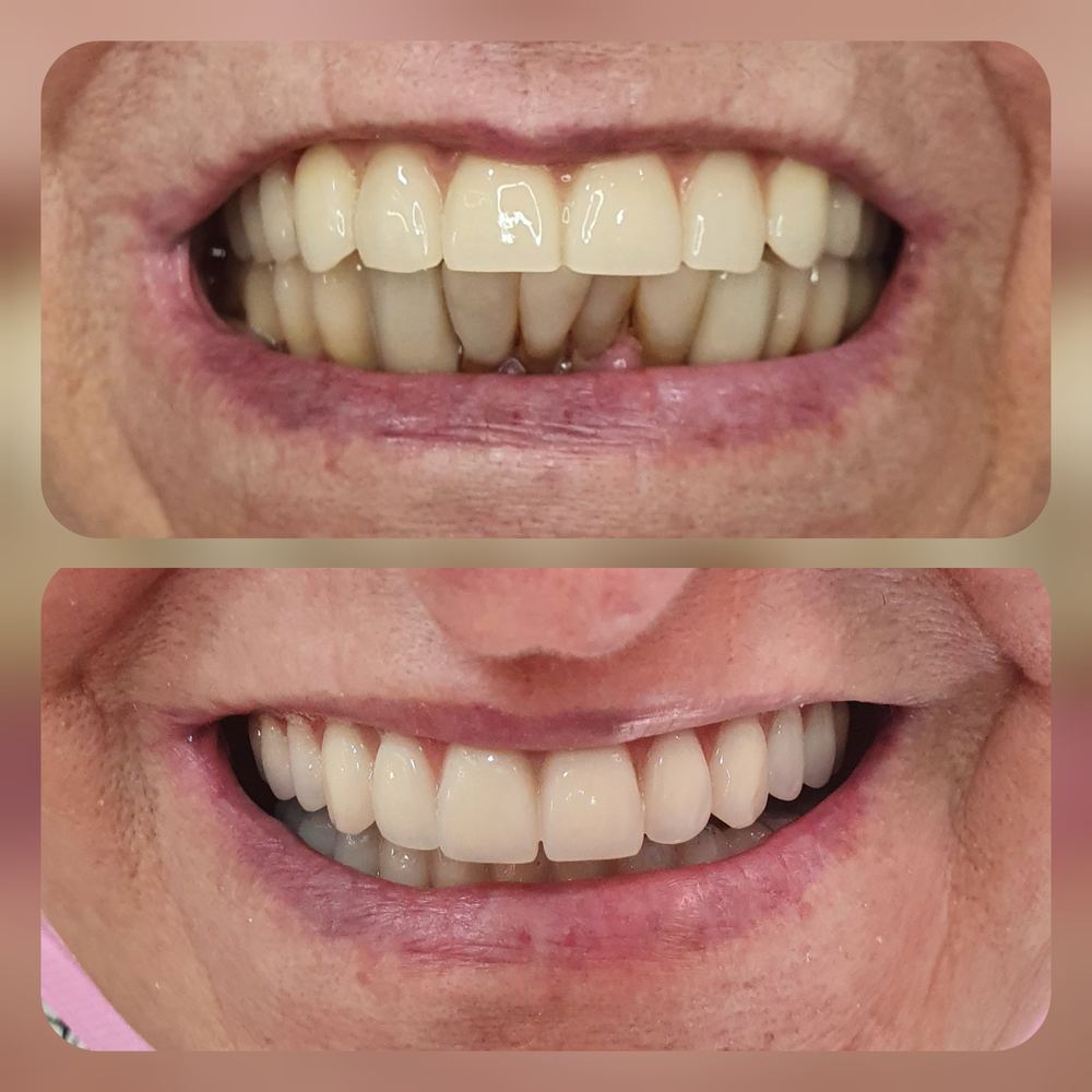 Transformação do sorriso com prótese sobre implante na Figuière Clinique Santo André