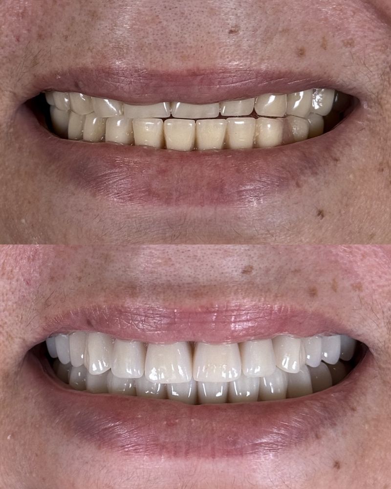 Resultado de reabilitação oral com implante na Figuière Clinique — Dentista de Alto Padrão no ABC